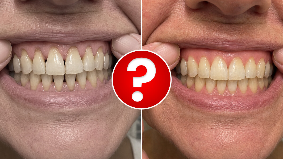 Can Receding Gums Really Grow Back? A Sydney Dermatologist Says Yes, And It Comes Down To THIS One Thing Dentists Overlook